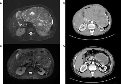 Adaptive Tomotherapy for locally advanced unresectable pancreatic neuroendocrine tumor: Case report and literature review